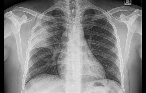 Lobar Pneumonia Critical Care Sonography