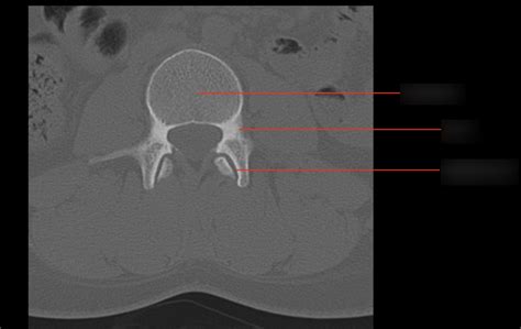 Lumbar Spine CT 2 Diagram Quizlet