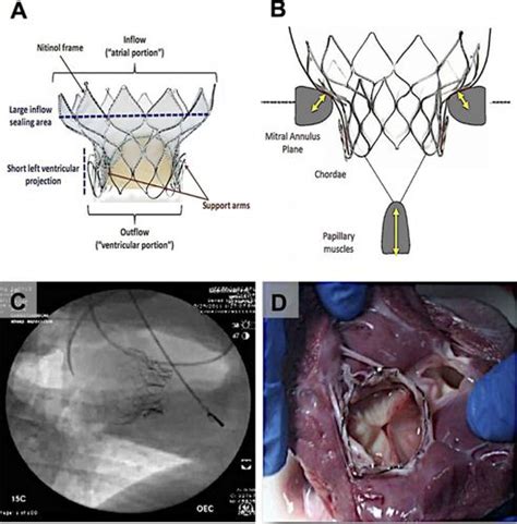 Percutaneous Transcatheter Mitral Valve Replacement Circulation