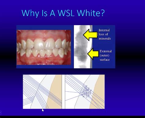 White Spot Lesions During Orthodontic Treatment Flashcards Quizlet