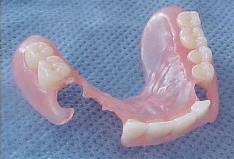 removable partial denture for one tooth - rollieroegner-99