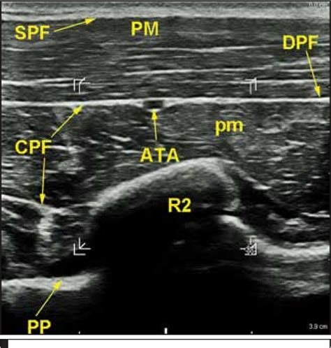 Figure 1 From Ultrasound Guided Continuous Interpectoral Block For