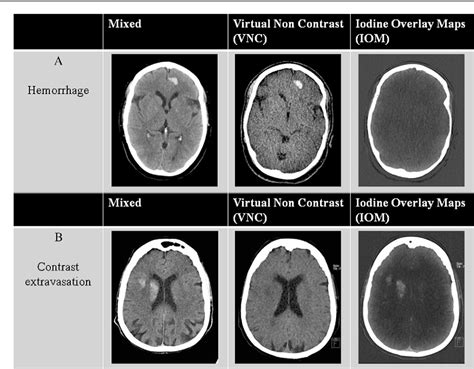 Ct Scan Brain Normal Vs Ischemic Stroke Images Non Contrast Images