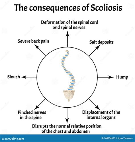 Le Conseguenze Della Scoliosi Curvatura Spinale Cifosi Lordosi Del