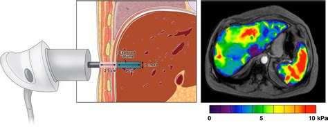 Elastography For Detecting Hepatic Fibrosis Options And Considerations