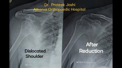 Anterior Shoulder Dislocation Reduction Technique Dr Prateek Joshi