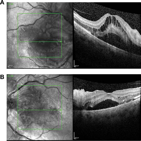 Figure From A Review Of Hypertensive Retinopathy And