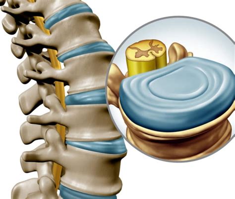 Disco Intervertebrale Anatomia Funzioni E Degenerazione