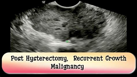 Post Hysterectomy Recurrent Mass Malignancy At Residual Cervical Stump Tvs Ultrasound