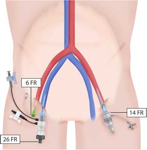 Simultaneous Transcatheter Aortic And Mitral Native Valve Replacement