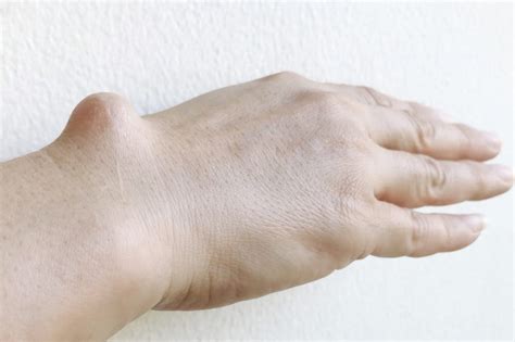 Wrist And Hand Cysts What To Know And How To Treat Them