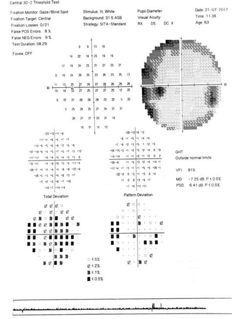 Visual field OS 3 weeks following admission: enlarged blind spot ...