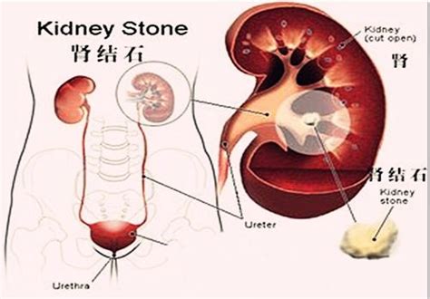 什麼是腎結石？有什麼症狀？形成原因？ 每日頭條