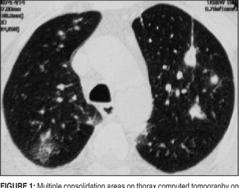 Figure 1 From A Case With Extranodal Marginal Zone Non Hodgkins Lymphoma Of The Lung Diagnosed