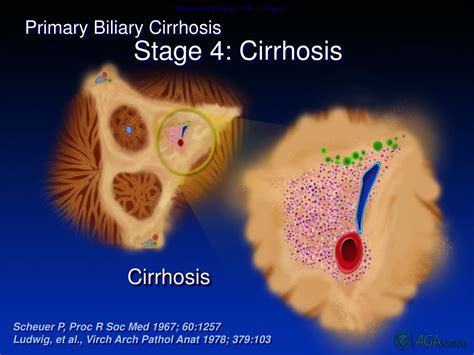 Ppt Cholestatic Liver Disease Pbc And Psc Powerpoint Presentation Free Download Id 5127077