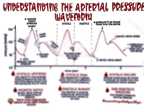 The Arterial Line ABP Waveform - Etsy