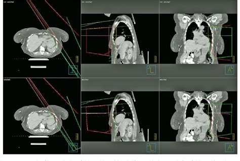 Figure 2 From A Threefield Monoisocentric Inverse Breast Treatment