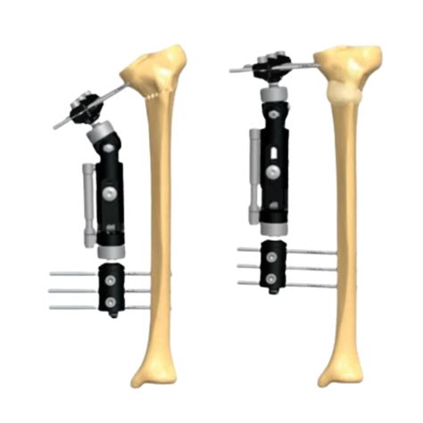 Quais S O Os Tipos De Fixadores Ortop Dicos