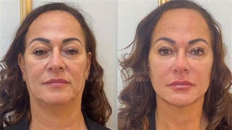 Mãe de Neymar mostra antes e depois de harmonização facial O Bom da