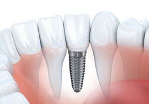 Plano Dental Implants - Plano Gentle Dental