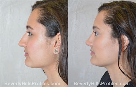 Before And After Rhinoplasty Pictures In Beverly Hills