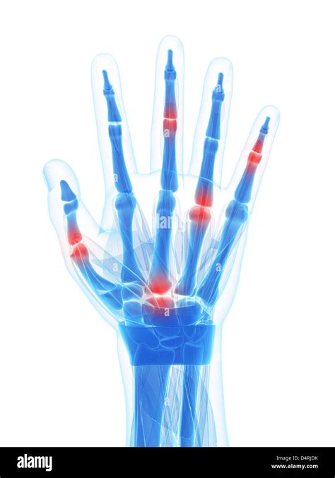 x-ray hand - arthritis Stock Photo - Alamy