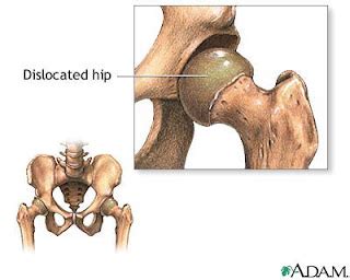 Free For Health: Congenital Hip Dislocation - Symptoms and How It Is Treated