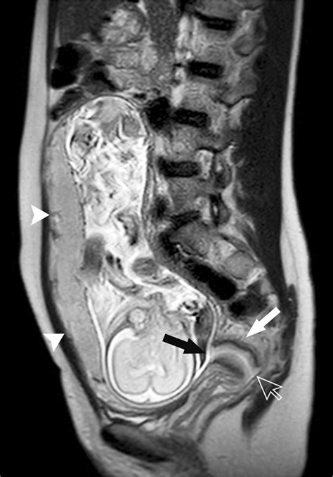 Cervix Sagittal T2 Weighted Single Shot Fast Spin Echo Mr Image In A Download Scientific