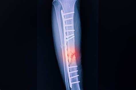 Premium Photo Xray Firm Of A Patient With Fracture Of Right Tibia