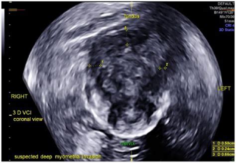 Predictive Value Of Three Dimensional Transvaginal Sonography For