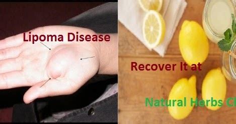 Lipoma Treatment: Lipoma Natural Treatment