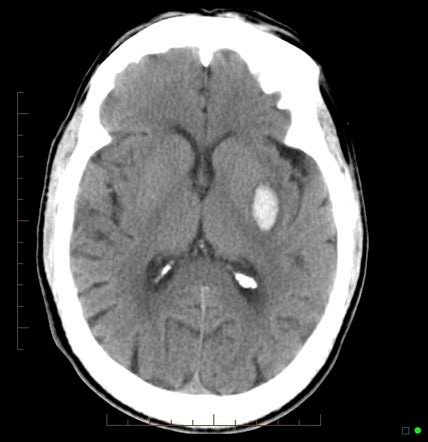 Unusual Case Of Spontaneous Bilateral Basal Ganglia Bleed, 50% OFF