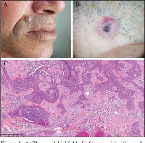 Figure 1 From Answer Toxic Epidermal Necrolysis Like Ten Like