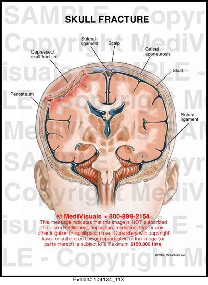 Medivisuals Skull Fracture Medical Illustration