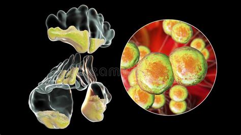 Infiammazione Purulenta Del Seno Frontale Destro E Vista Di Chiusura