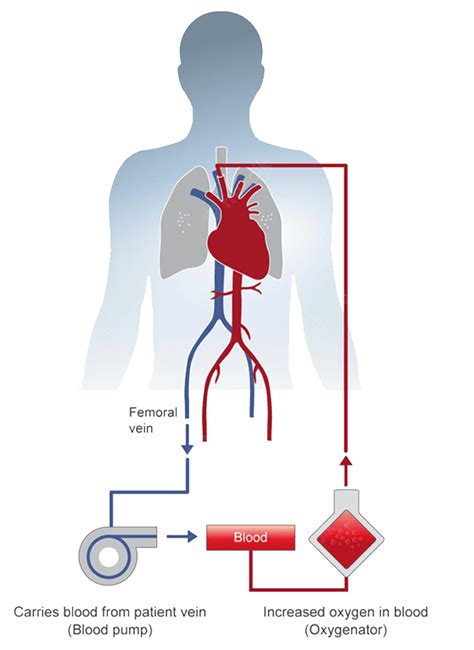 Ecmo Campaign Sps Hospitals