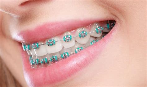 6 Tips For Maintaining Oral Hygiene With Braces