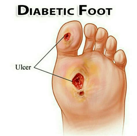 Diabetic Foot And Diabetic Foot Infection – Pasindu Suriapperuma – Medium