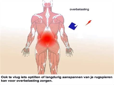 Lage Rugpijn Oorzaken En Behandeling Youtube