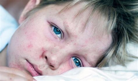 Measles Mapped As Cases Surge Through Uk Areas Infection Is Spreading Most Verve Times