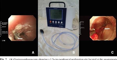 Figure 2 From Endoscopic Vacuum Assisted Closure E Vac Treatment In A Patient With Delayed