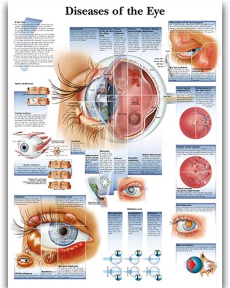 Diseases of The Eye Anatomy Posters For Walls Nursing Students ...