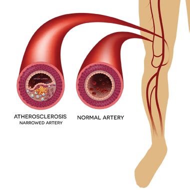 Peripheral Arterial Disease Symptoms