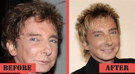 Barry Manilow Before And After Plastic Surgery Celebrity Plastic