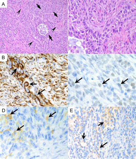 Pathological Features Of The Testicular Tumor A The Download