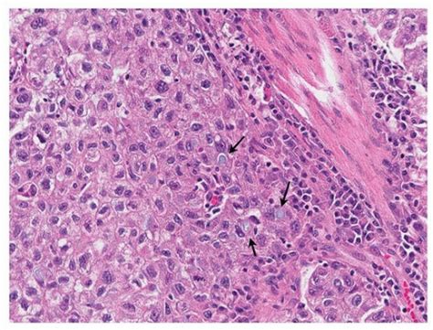 Adenocarcinoma Nonmucinous Thoracic Key