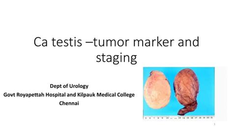 Testis Carcinoma Staging And Tumour Markers Ppt