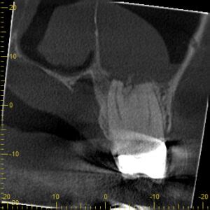 Minimally Invasive Endodontics With Laser Activated Irrigation