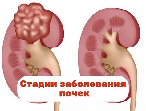 Стадии заболевания почек: описание 1 2 3 4 5 стадии заболевания почек