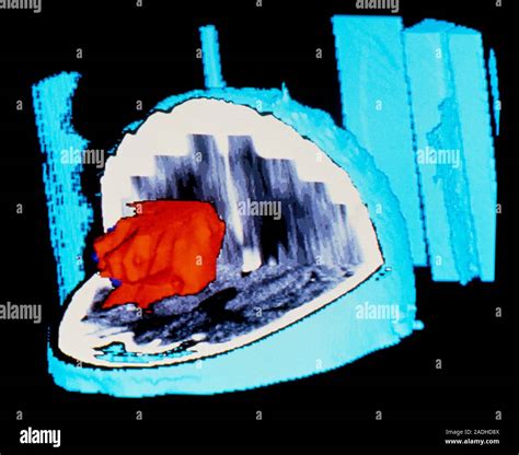 Tumor Cerebral Glioblastoma D De Color Tomograf A Computarizada Que